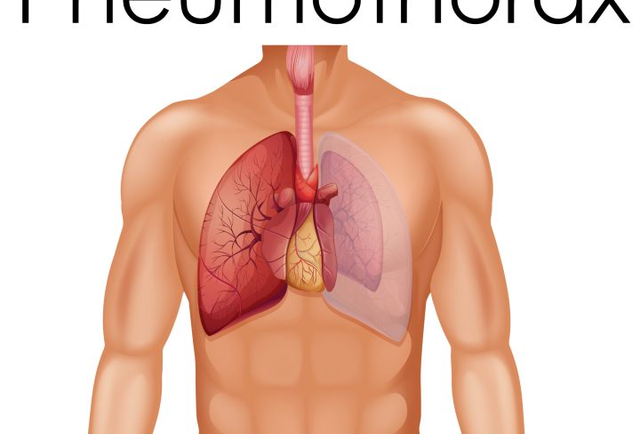 A Human Anatomy of Pneumothorax  illustration